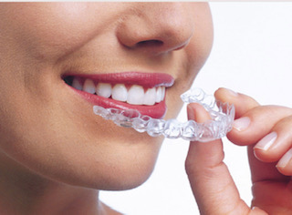 Invisalign, Orthodontie invisible