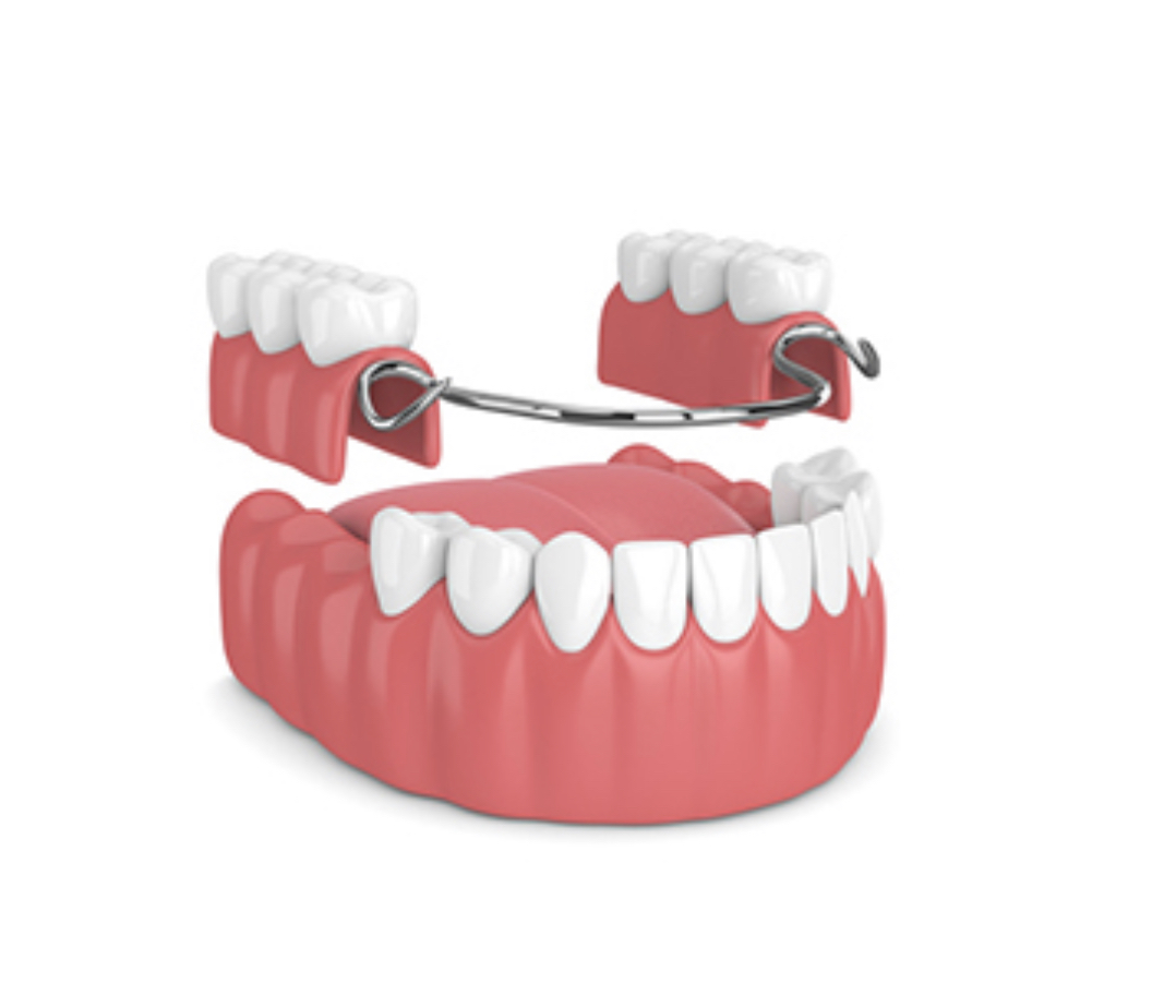 Prothése partielle, prothése totale, prothése complète, prothése sur implants